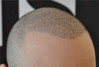 head-hair-tattoo-bald
