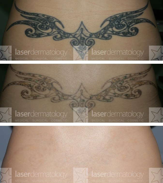 Laser Dermatology Laser Tattoo Removal