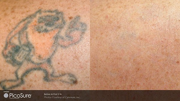 Laser Focus Laser Tattoo Removal